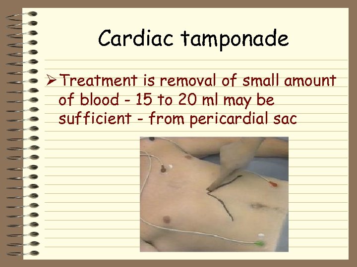Cardiac tamponade Ø Treatment is removal of small amount of blood - 15 to