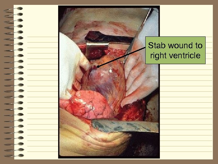 Stab wound to right ventricle 