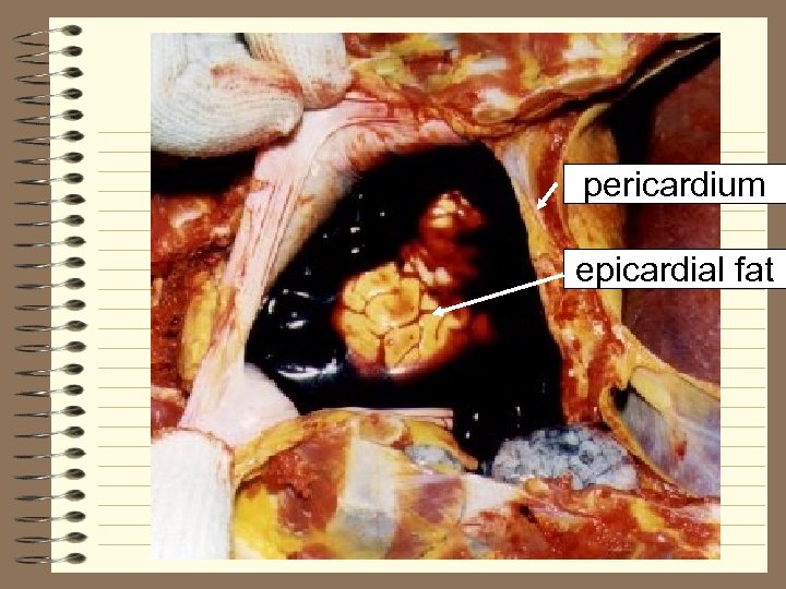 pericardium epicardial fat 