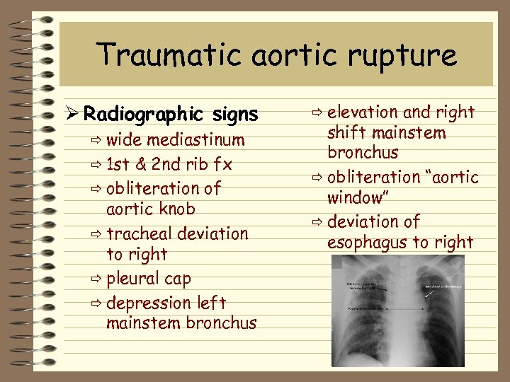 Traumatic aortic rupture Ø Radiographic signs ð wide mediastinum ð 1 st & 2