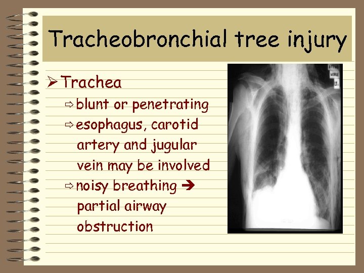 Tracheobronchial tree injury Ø Trachea ð blunt or penetrating ð esophagus, carotid artery and