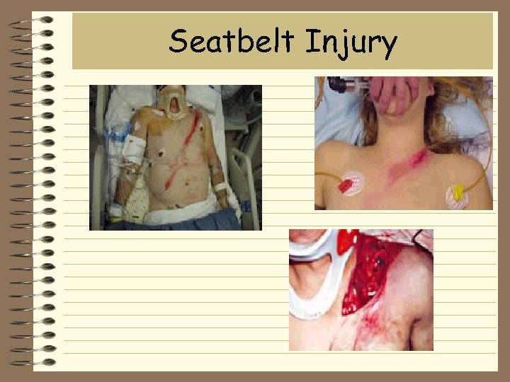 Seatbelt Injury 