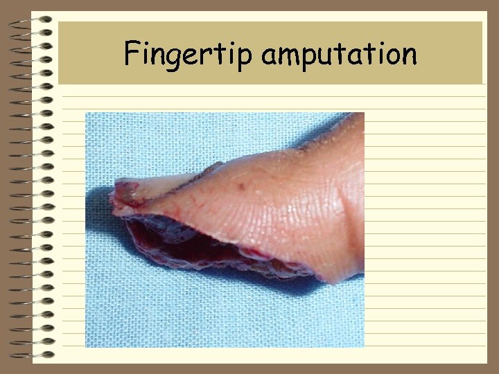 Fingertip amputation 