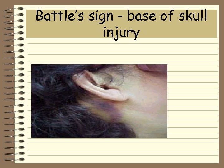 Battle’s sign - base of skull injury 