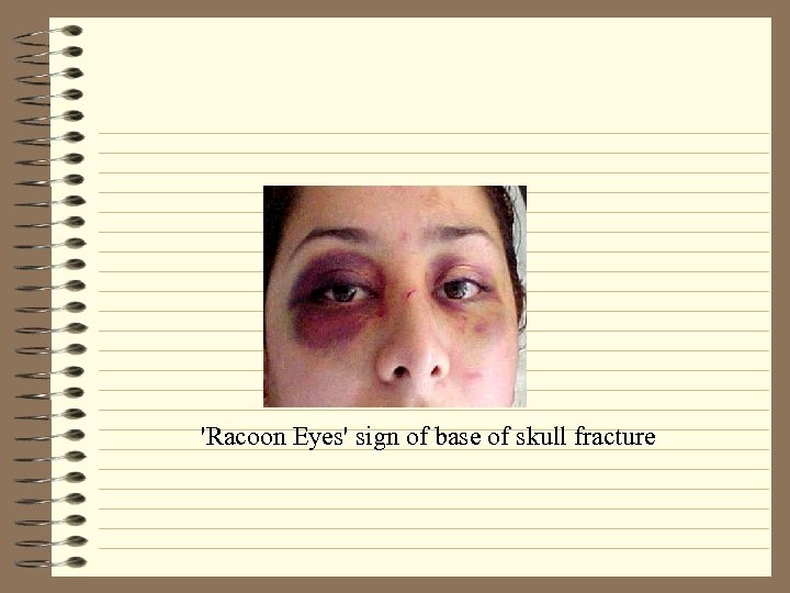 'Racoon Eyes' sign of base of skull fracture 