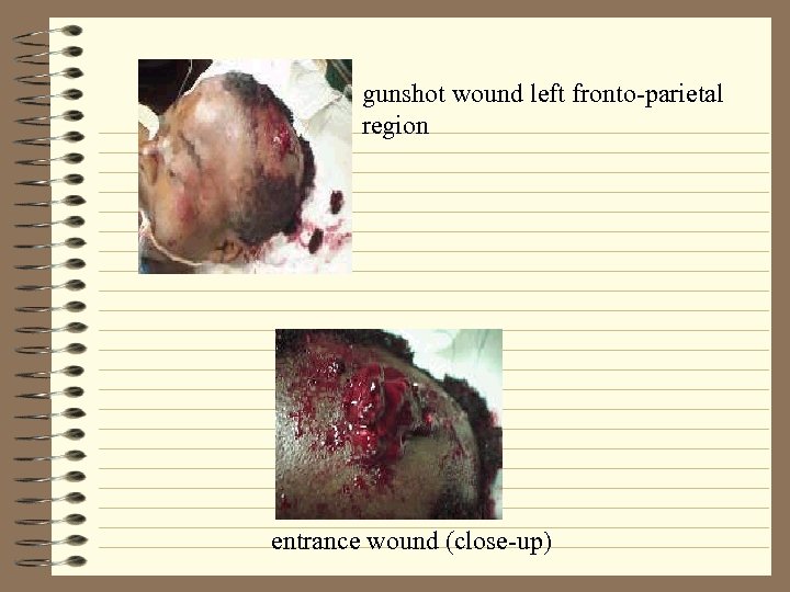 gunshot wound left fronto-parietal region entrance wound (close-up) 