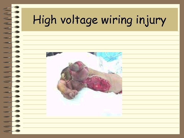 High voltage wiring injury 