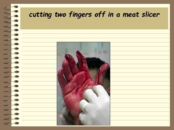 cutting two fingers off in a meat slicer 