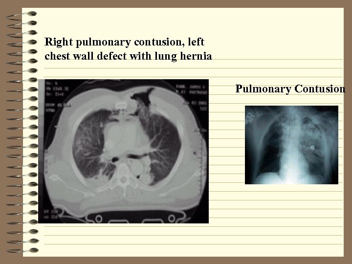 Right pulmonary contusion, left chest wall defect with lung hernia Pulmonary Contusion 