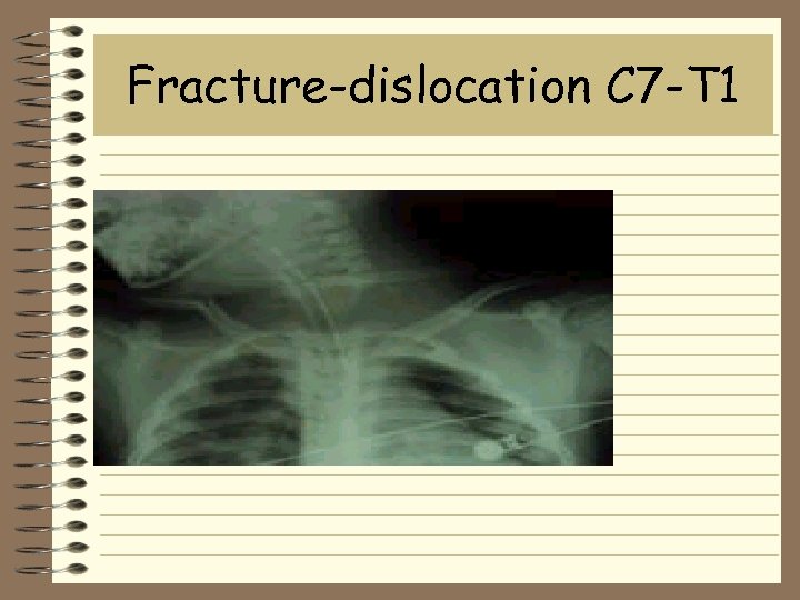 Fracture-dislocation C 7 -T 1 