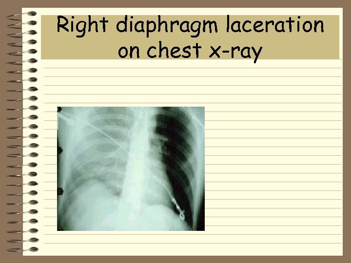Right diaphragm laceration on chest x-ray 
