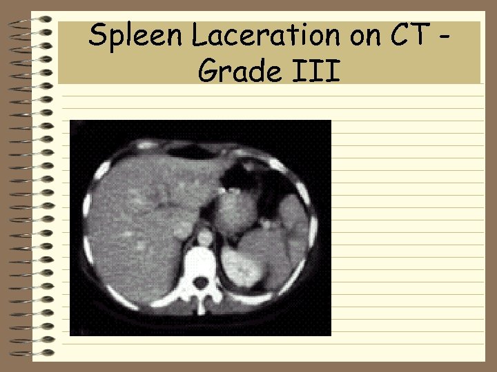 Spleen Laceration on CT Grade III 