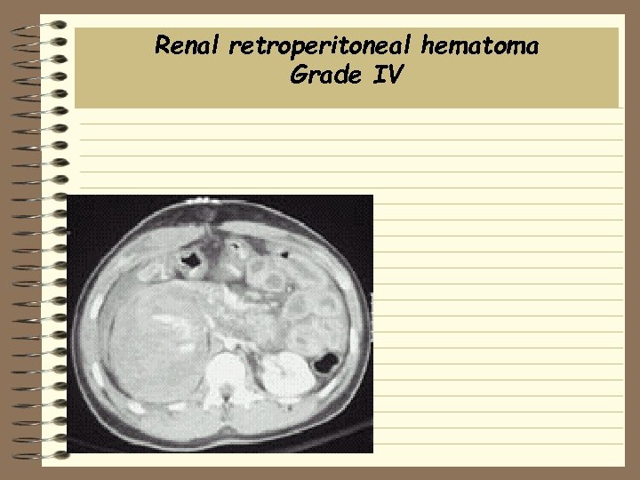 Renal retroperitoneal hematoma Grade IV 