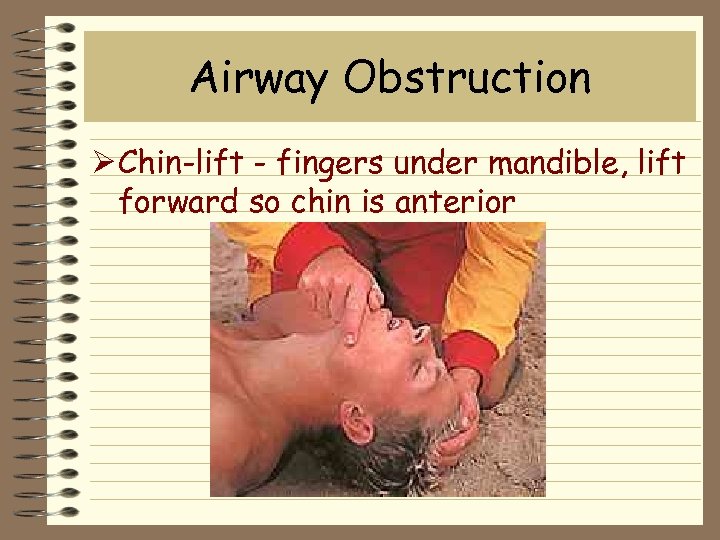 Airway Obstruction Ø Chin-lift - fingers under mandible, lift forward so chin is anterior