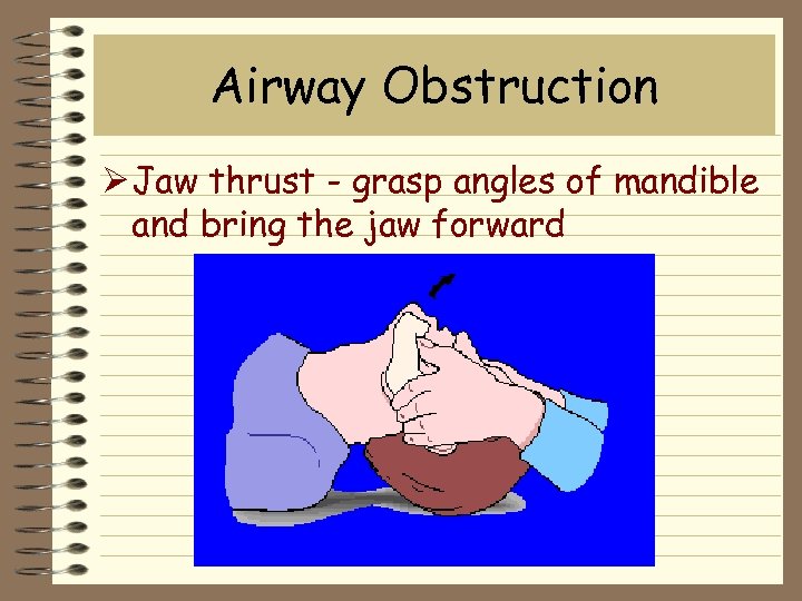 Airway Obstruction Ø Jaw thrust - grasp angles of mandible and bring the jaw