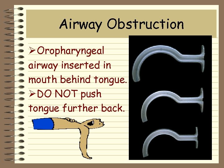 Airway Obstruction Ø Oropharyngeal airway inserted in mouth behind tongue. Ø DO NOT push
