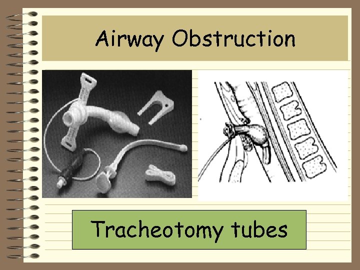 Airway Obstruction Tracheotomy tubes 