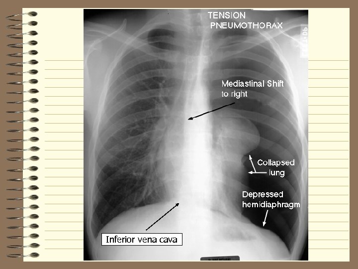 Inferior vena cava 