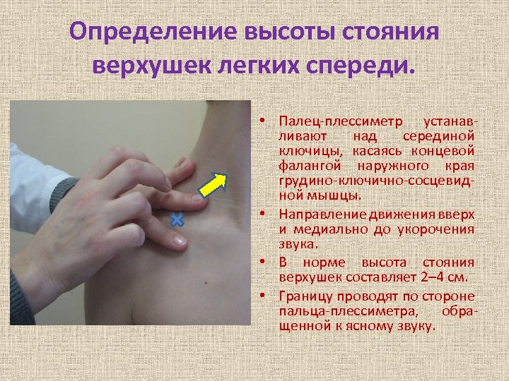 Определение высоты стояния верхушек легких спереди. • Палец-плессиметр устанавливают над серединой ключицы, касаясь концевой