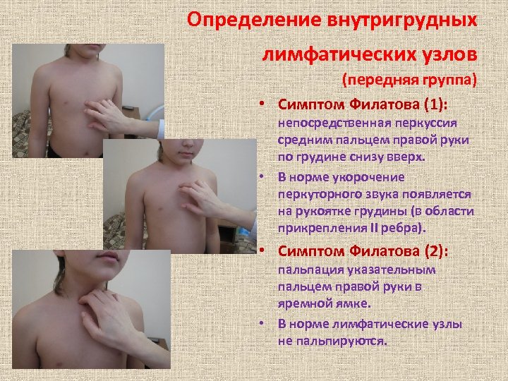 Определение внутригрудных лимфатических узлов (передняя группа) • Симптом Филатова (1): непосредственная перкуссия средним пальцем