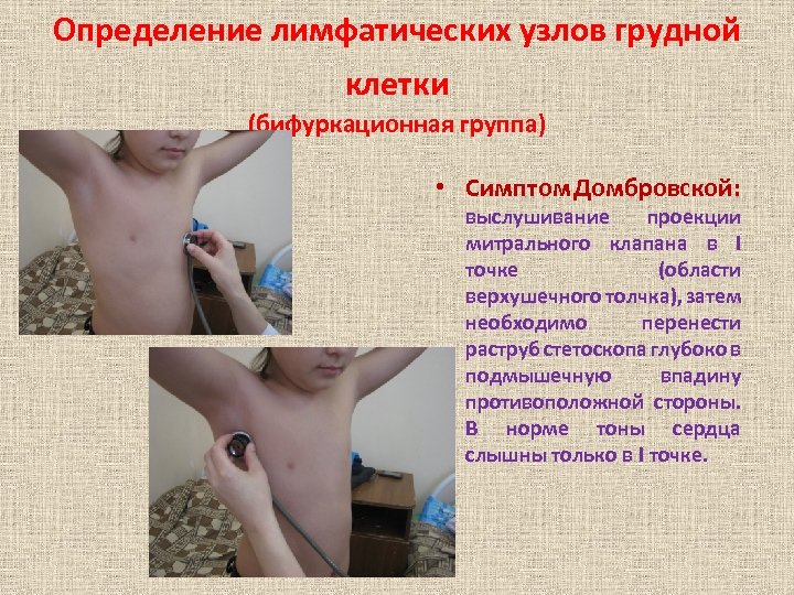 Определение лимфатических узлов грудной клетки (бифуркационная группа) • Симптом Домбровской: выслушивание проекции митрального клапана