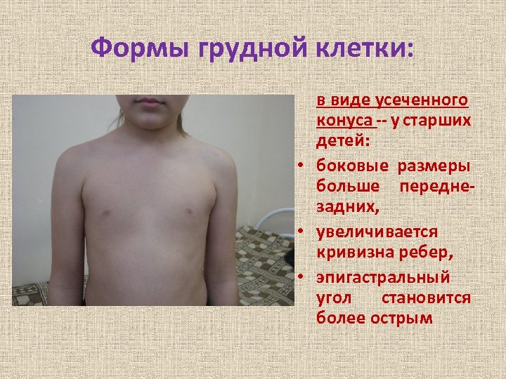 Формы грудной клетки: в виде усеченного конуса -- у старших детей: • боковые размеры
