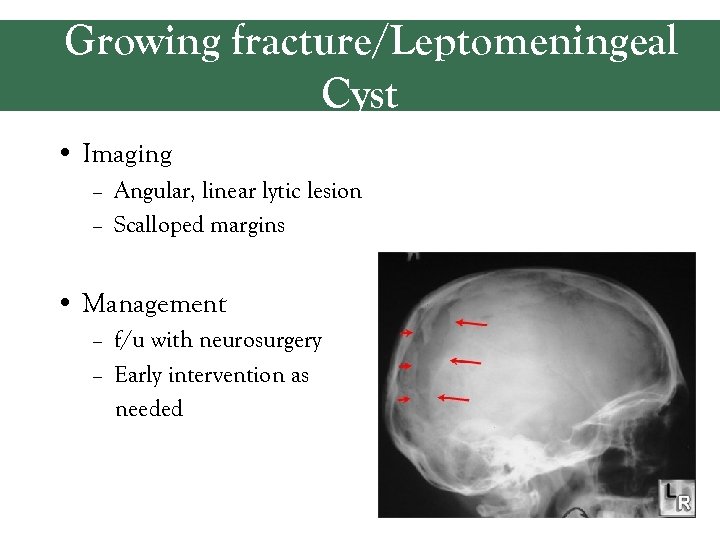 Growing fracture/Leptomeningeal Cyst • Imaging – Angular, linear lytic lesion – Scalloped margins •