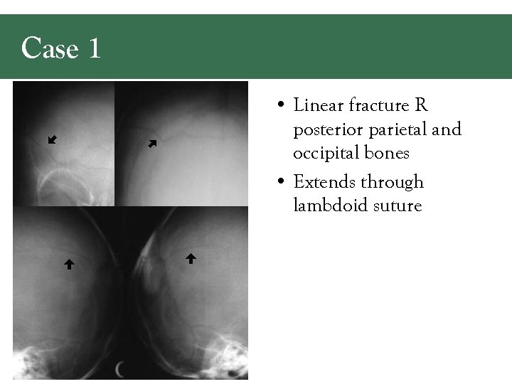 Case 1 • Linear fracture R posterior parietal and occipital bones • Extends through