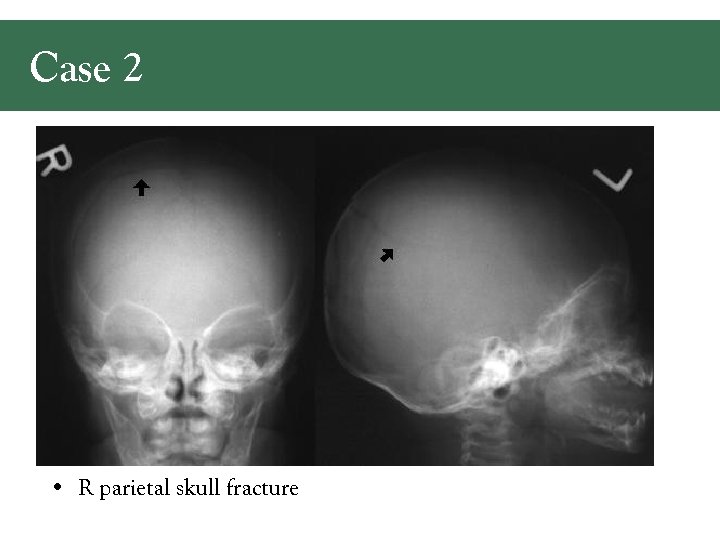 Case 2 • R parietal skull fracture 