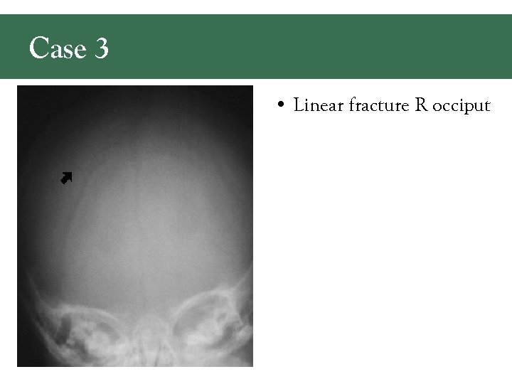 Case 3 • Linear fracture R occiput 