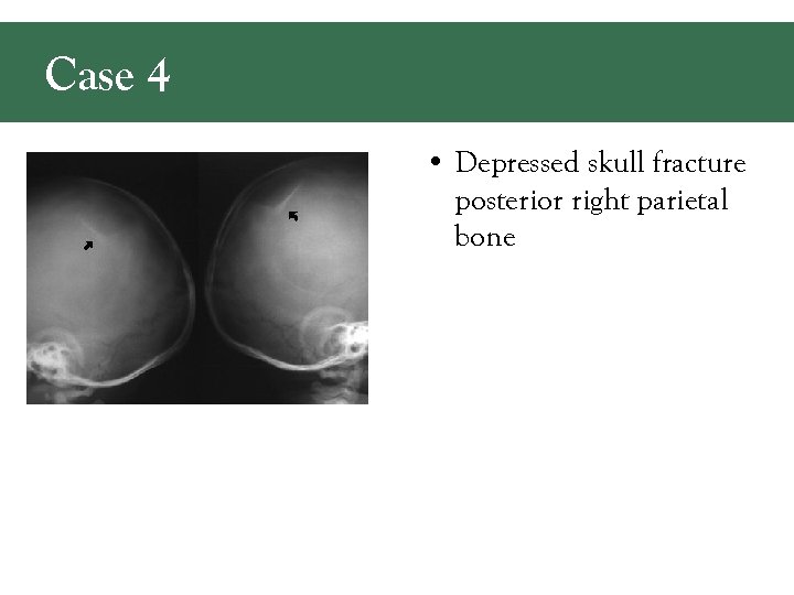 Case 4 • Depressed skull fracture posterior right parietal bone 