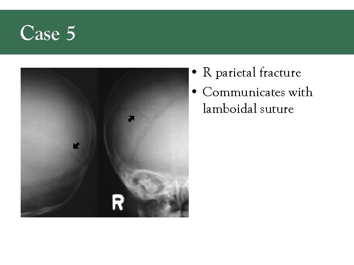 Case 5 • R parietal fracture • Communicates with lamboidal suture 