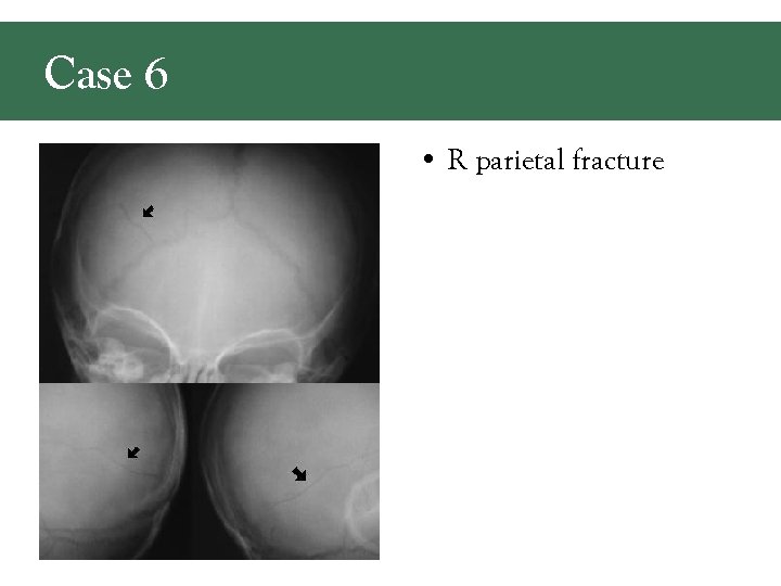 Case 6 • R parietal fracture 