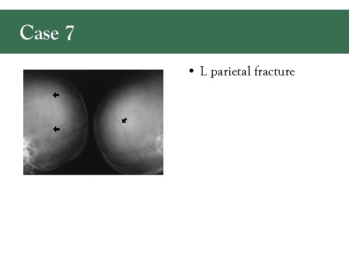 Case 7 • L parietal fracture 