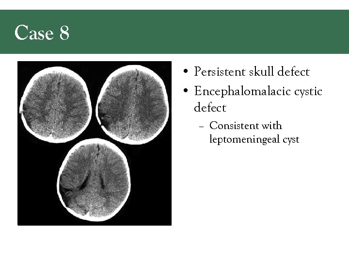 Case 8 • Persistent skull defect • Encephalomalacic cystic defect – Consistent with leptomeningeal