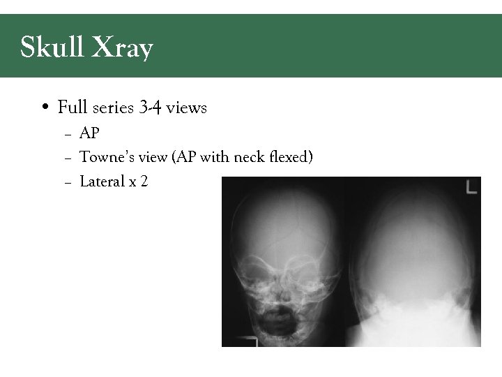 Skull Xray • Full series 3 -4 views – AP – Towne’s view (AP