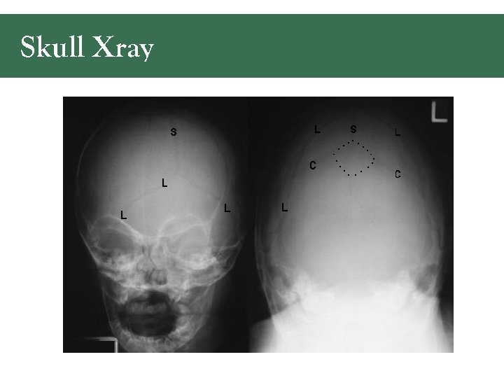 Skull Xray 