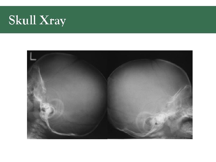 Skull Xray 