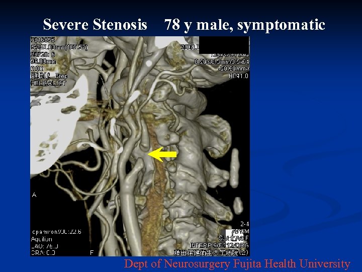 Severe Stenosis　78 y male, symptomatic Dept of Neurosurgery Fujita Health University 