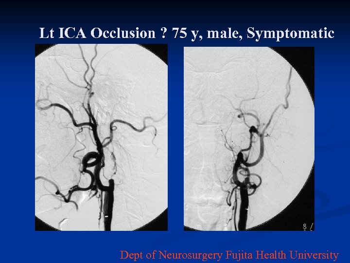 Lt ICA Occlusion ? 75 y, male, Symptomatic Dept of Neurosurgery Fujita Health University