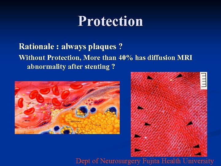 Protection Rationale : always plaques ? Without Protection, More than 40% has diffusion MRI