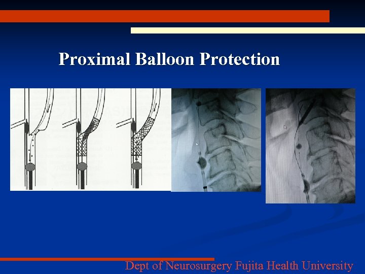 Proximal Balloon Protection Dept of Neurosurgery Fujita Health University 