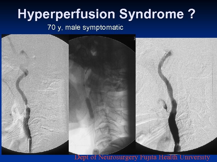 Hyperperfusion Syndrome ? 70 y, male symptomatic Dept of Neurosurgery Fujita Health University 