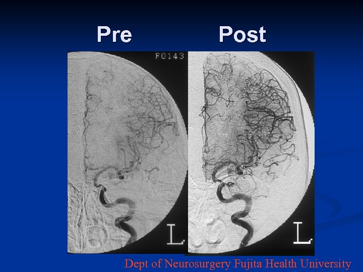 Pre Post Dept of Neurosurgery Fujita Health University 