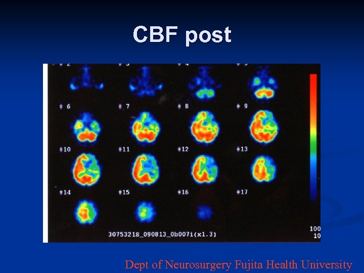 CBF post Dept of Neurosurgery Fujita Health University 