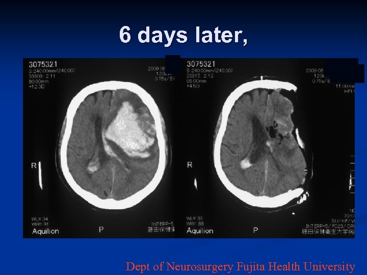 6 days later, Dept of Neurosurgery Fujita Health University 