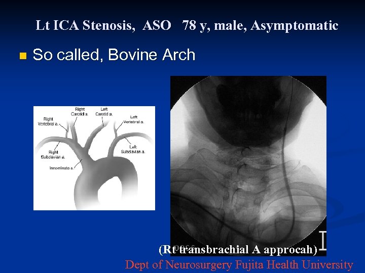 Lt ICA Stenosis, ASO 78 y, male, Asymptomatic n So called, Bovine Arch (Rt