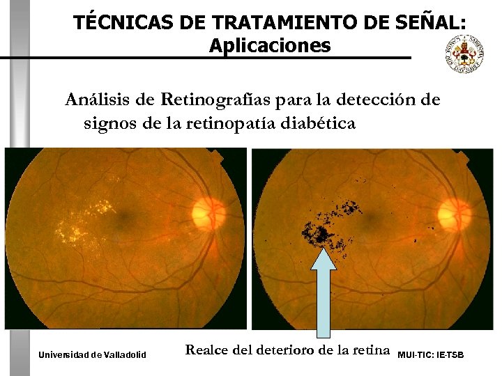 TÉCNICAS DE TRATAMIENTO DE SEÑAL: Aplicaciones Análisis de Retinografías para la detección de signos