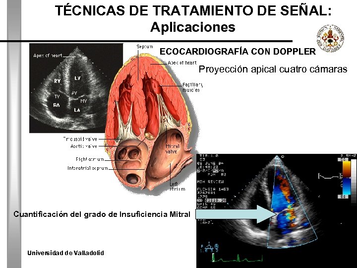 TÉCNICAS DE TRATAMIENTO DE SEÑAL: Aplicaciones ECOCARDIOGRAFÍA CON DOPPLER Proyección apical cuatro cámaras Cuantificación