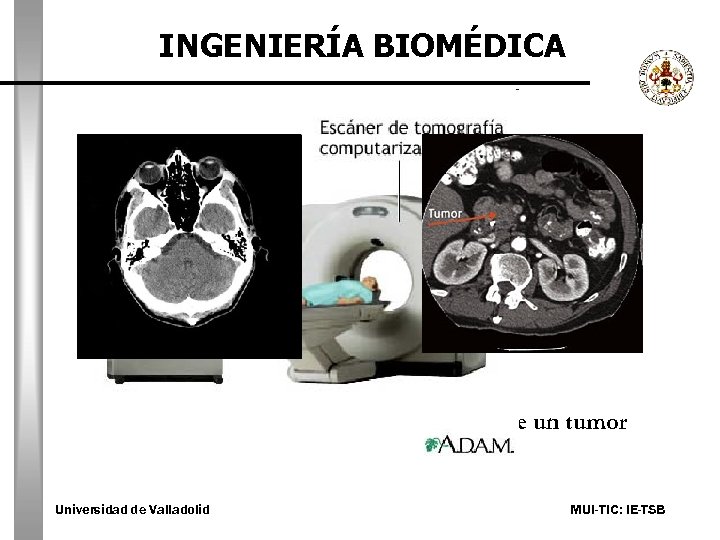 INGENIERÍA BIOMÉDICA Sección del cerebro Detección de un tumor Universidad de Valladolid MUI-TIC: IE-TSB